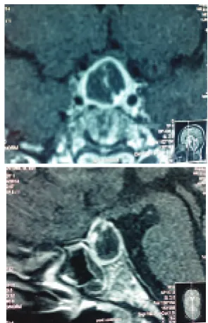 Figure 1. A) Brain MRI Sagittal View T1W1 Sequence B) T2 Sequence Showing a Voluminous Sellar Lesion with Suprasellar Extension that Extends into the Sphenoidal Sinus 