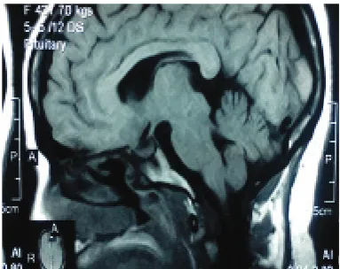 Figure 4. Absence of Focal Lesion or Visible Intra-sellar Collection. The Pituitary Stalk is Centrally Located with no Visible Suprasellar Abnormality