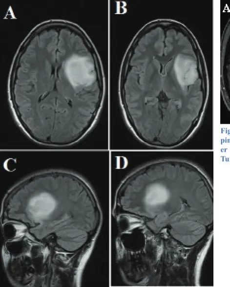 Figure 1. Axial (A&B) and Sagittal (C&D) Sections of Pre-operative MRI; Showing a Left Insular Tumor with In-volvement of the Left Opercular Cortex