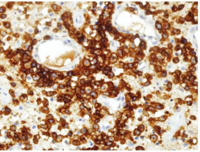 Figure 2. Kaplan-Meier curve of event-free survival and overall survival according to nuclear diameter of tumor cells (NDTC) group.