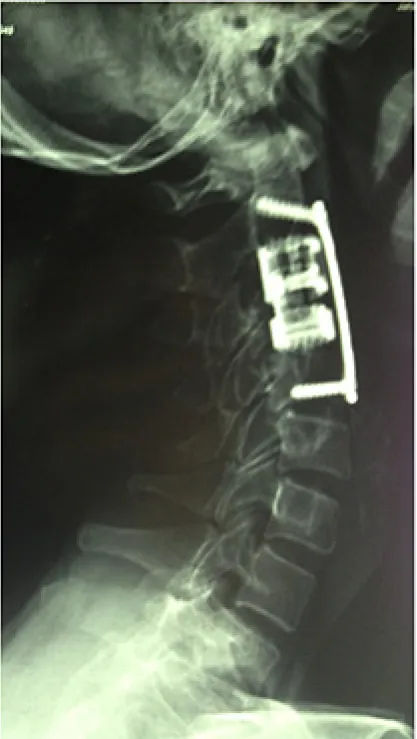 Figure 5. Post-operative Lateral Radiograph 