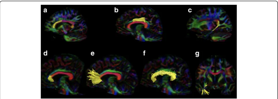 Fig. 1 Illustrations of segmented tracts. Upper row illustrates reconstructions of the cingulum with the subgenual cinguli to the left (retrosplenal or rostral cingulum in the middle (a), theb), and the hippocampal cingulum to the right (c)