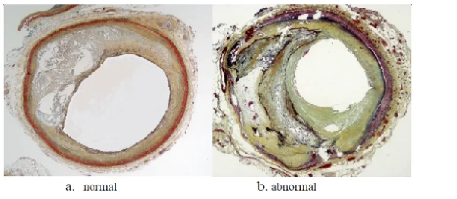 Figure 1: Shows Goff artery (normal and abnormal).
