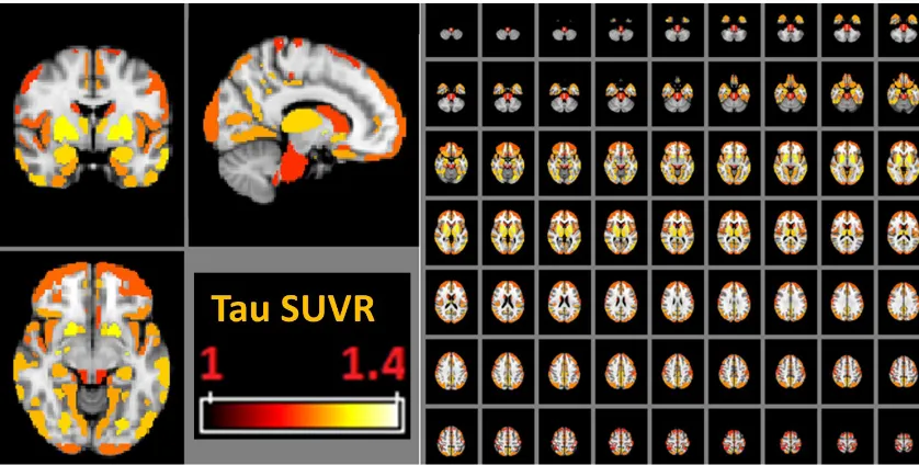 Figure 1. Higher temporal deposition especially in the hippocampus, the inferior temporal, and subcortical putamen/palladium (considered “off-target” binding) compared to mean cortical deposition and cerebellum (SUVR = 1) from group-averaged tau image.