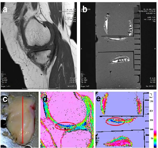 Figure 3. Case A: comparative evaluation between in-vivo (a and d) and in-vitro formalin-fixed tissue (b and e)
