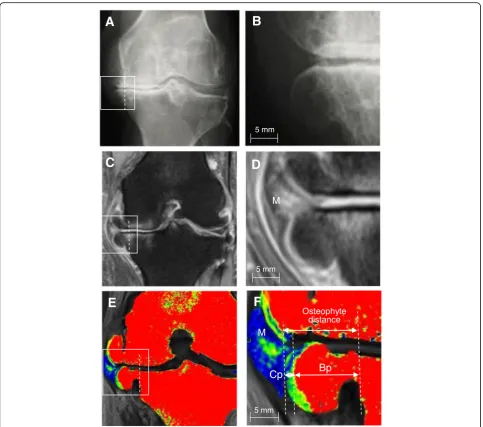 Fig. 3 Findings of medial tibial osteophytes by radiography, proton density-weighted magnetic resonance imaging (MRI), and T2 mapping MRI.joint shown in (MRI with fat suppression of the same knee joint shown in (a Representative radiograph of the end-stage