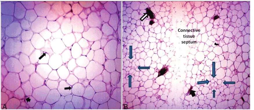 Figure 4. A: Histopathologic examination of the tumor reveals the mature regular adipose cells of almost similar sizes and eccentric normal nuclei (black arrows)
