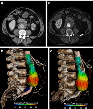 Fig. 1 Rapid enlargement rate. aAxial enhanced CT and b 3Drendering image with a colourparametric map of a 71-year-oldman shows a 5.4-cm AAA