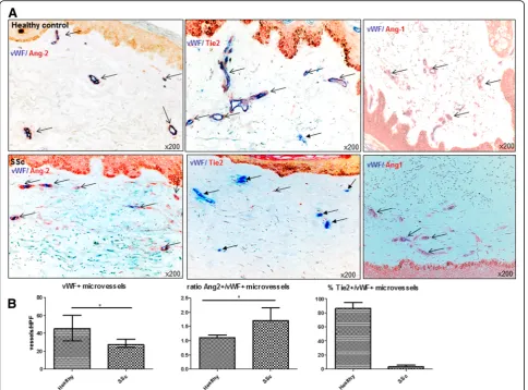 Fig. 2 Expression of Ang/Tie2 in dermal microvessels of SSc patients and controls.semi-quantitative analyses of dermal Ang-2 and mbTie2 expression as well as the reduced microvascular density of SSc patients compared withhealthy controls