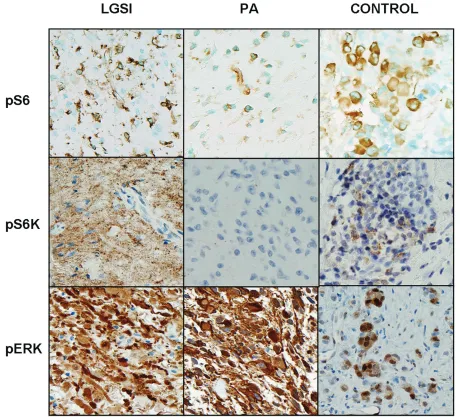 Figure 5. Increased frequency of combined phospho-S6/phospho-S6 kinase is present in low grade astrocytomas subtype indeterminate (LGSI)