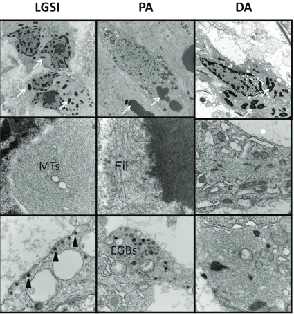Figure 1. Low grade astrocytomas subtype indeterminate (LGSI) demonstrate ultrastructural features of glial as well as neuronal differentiation