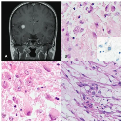 Figure 2. A subset of NF1-associated low grade as-trocytomas show distinctive morphology