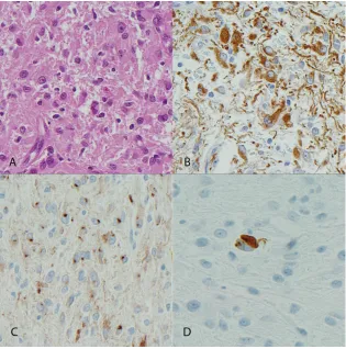 Figure 3. Low grade astrocy-tomas subtype indeterminate (LGSI) express neuronal asso-ciated proteins
