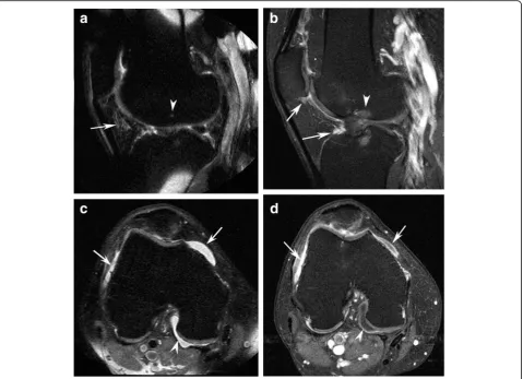Fig. 2 aseen on non-CE-MRI, as well as bone marrow edema ( Sagittal fat-suppressed proton density-weighted image (non-CE-MRI) shows hyperintensity in the intercondylar (arrow) region of Hoffa’s fat pad.This signal alteration is used as a surrogate marker f