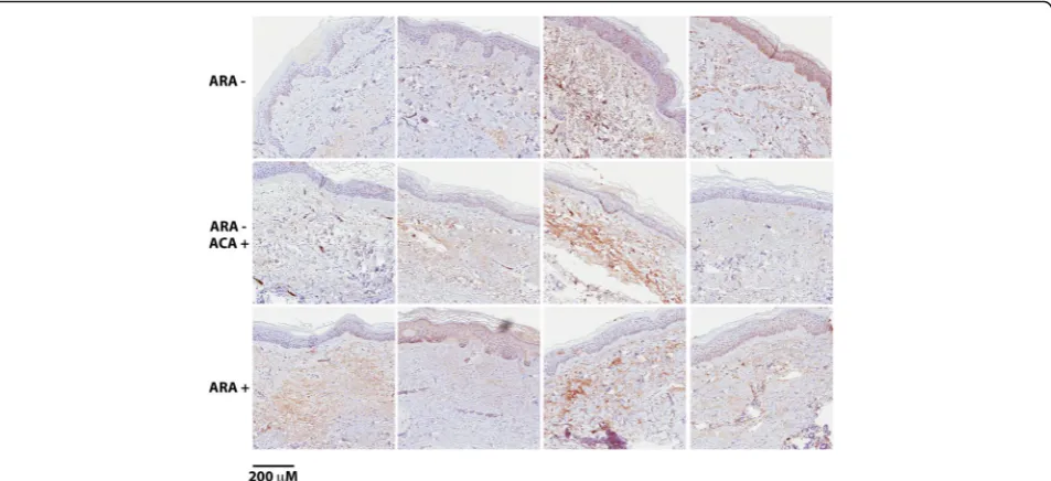 Fig. 3 C3b deposition in kidney biopsies from patients with scleroderma renal crisis (SRC)
