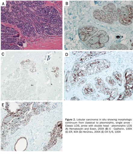 Figure 2. Lobular carcinoma in situ showing morphologic continuum from classical to pleomorphic, single arrow -