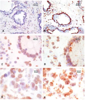 Figure 2. Representative in situ hybridization of PAP mRNA. High power photomicrographs (60x) showing expression of PAP mRNA in the glandular epithelium of a normal prostate gland from sample DI 14050 (A and B), mucosal epithelial cells of normal colon fro