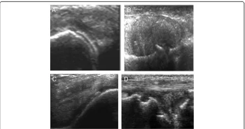 Fig. 1 Gout signs: a double contour signs and b tophus. CPP signs: c linear hyperechoic deposit inside the cartilage and d in the meniscus