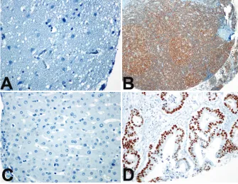 Figure 1. Represenative p53 and D. Cancer tissue core stained for p53 (x200) ; note lack of staining in C