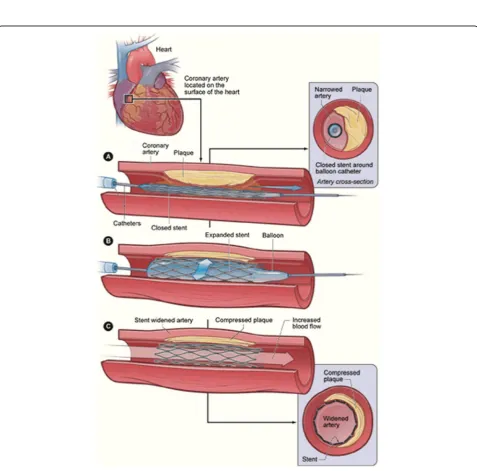 Fig. 1 Atherosclerosis sequence (Widmer et al. 2016)