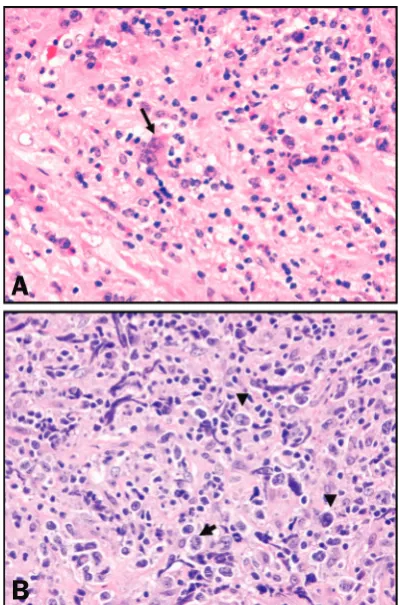 Table 1. Common lymphomas with overlapping or “grey zone” features