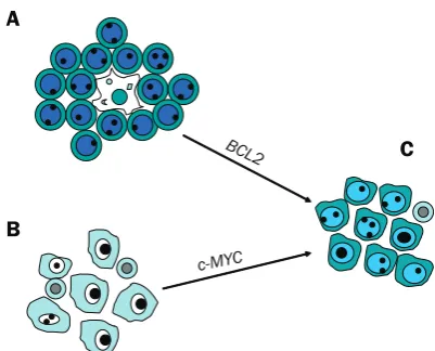 Figure 3. A model to explain the occurrence of aggressive B-cell lymphoma with atypical mor-phology