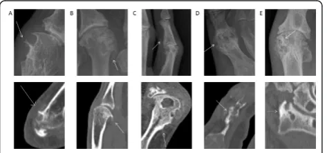 Figure 1 Examples of the features of new bone formation(NBF) observed by plain radiography and computedtomography in patients with gout