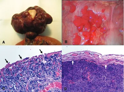 Figure 1. Examples of the serosal penetration/tumor rupture in GISTs. (A) Pedunculated GIST from the ileum showed a whitish plaque-like depressed serosal defect indicating an old perforation/tumor rupture