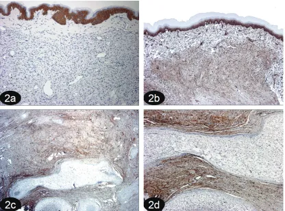 Figure 2. (a) CD44v6 positivity in normal epithelium (serving as an internal control) and absence of immunoreactivity in the underlying cutaneous neurofibroma
