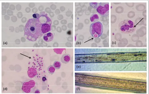 Figure 4. Microscopic fi ndings in hemophagocytic lymphohistiocytosis and conditions predisposing to it
