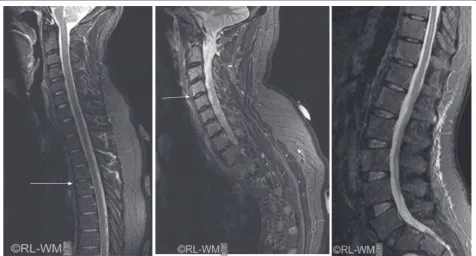 Figure 1. Reference images (Canada-Denmark International MRI Group) of STIR MRI, illustrating the sagittal view of the cervico-thoracic spine