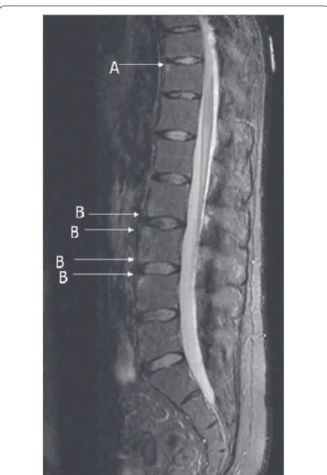 Figure 2. Reference image of short tau inversion recovery MRI illustrating type A and type B corner infl ammatory lesions