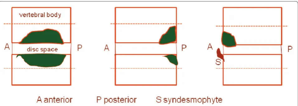 Figure 3. Schematic illustrating a discovertebral unit (the space between two horizontal lines drawn through the middle of adjacent vertebrae) with areas of bone marrow edema at diff erent locations within the unit
