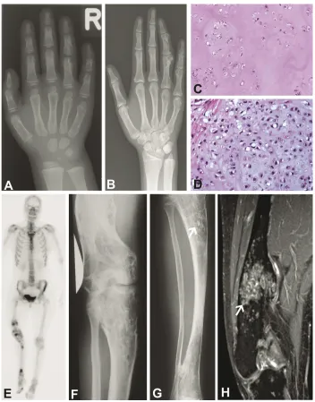 Figure 2. Ollier disease. (A) 4-year-old female patient with Ollier disease. Multiple enchondromas, manifesting as cen-tral end eccentric osteolytic lesions and deformities in the metacarpals and phalanges of the fourth and fifth ray of sclerosis