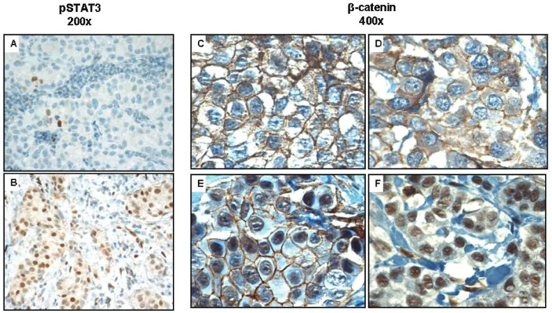 Figure 6. The biologic importance of Downregulation of β-catenin in breast cancer. A, B) β-catenin using 