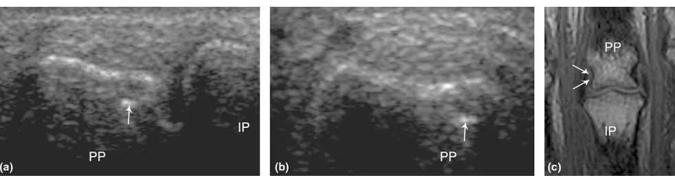 Figure 3(a) in a longitudinal view(a) Bone cortex defect (arrows) on ultrasonography in a 63-year-old healthy control person on the radial side of the 3rd proximal interphalangeal joint Bone cortex defect (arrows) on ultrasonography in a 63-year-old healthy control person on the radial side of the 3rd proximal interphalangeal joint (b) (c) 