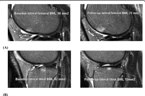 Figure 1 Examples of bone marrow lesion (BML) change. (a)BML increase from baseline to follow-up
