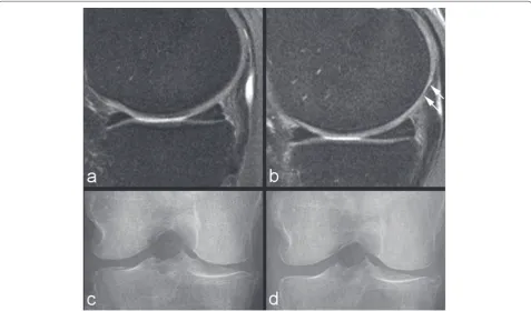 Figure 4. Example of non-sensitivity of radiography. (a) Baseline sagittal intermediate-weighted fat-suppressed image shows normal articular cartilage coverage in the medial femur and tibia