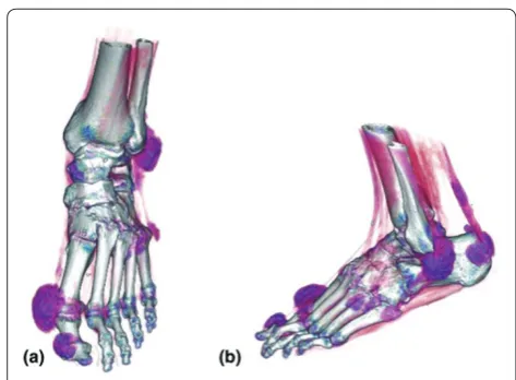 Figure 2. Three-dimensional reconstruction of helical multidetector computed tomography scan of the foot of a patient with tophaceous gout