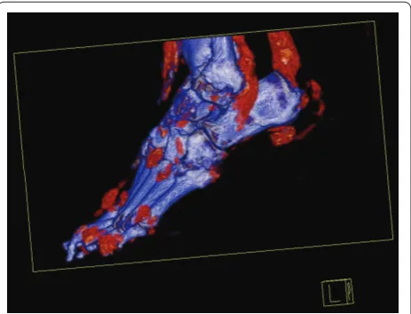 Figure 5. Dual-energy computed tomography scan of the foot of a Pacifi c islander man with longstanding gout