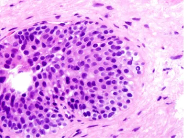 Figure 3 Transitional cell (urothelial) metaplasia of the prostatic gland. As a benign condition, urothelial metaplasia of the prostate can mimic HGPIN