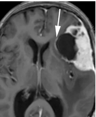Fig. 16 Axial FLAIR sequence in an 81-year-old woman with confusionand falls demonstrates a large extra-axial mass that is isointense to greymatter and is predominantly located within the right frontal lobe butcrosses the midline falx anteriorly to indent 