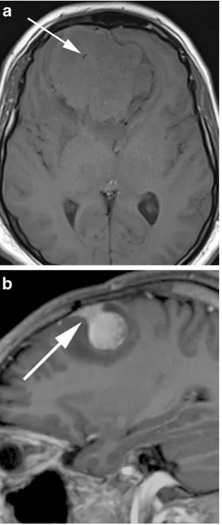 Fig. 20 Post-contrast coronal T1-weighted sequence in a 70-year-oldwoman with headaches demonstrates a mildly heterogeneously enhanc-ing mass indenting the right precentral gyrus (arrow) with a broad duralattachment and marked surrounding vasogenic oedema