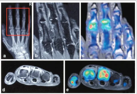 Figure 2. Image co-registration in rheumatoid arthritis. Images from a patient with early rheumatoid arthritis, obtained using three diff erent modalities