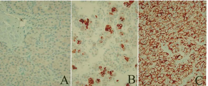 Figure 3 Immunohistochemical study for claudin-7 expression in renal oncocytomas. These tumors show a full spectrum of staining patterns from negative staining (A) to focal scattered positive staining (B) to strong, diffuse membranous staining (C) (origina