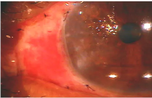 Figure 1.  Recurrent pterygium of the left eye.