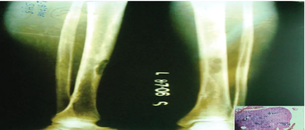 Figure 2. MRI showing thickened cortex with recurrent lytic lesion in tibia