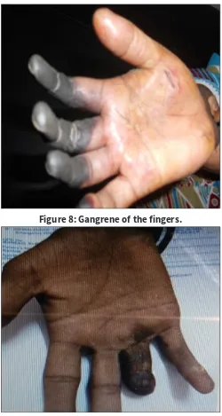 Figure 8: Gangrene of the fingers.