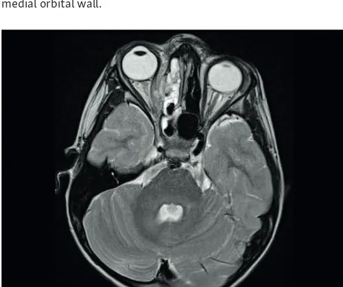 Fig. 1 CT, horizontal section: left-sided pansinusitis, defect of lamina papyracea, inflammatory infiltration with air bubble along medial orbital wall
