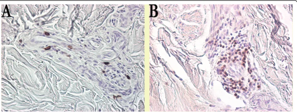 Figure 3 B and T cell staining in systemic sclerosis biopsies. In a forearm biopsy, immunohistochemistry revealed an expression ofthe B-cell marker CD20 in a limited number of (a) lymphocytes while a prominent expression of the T-cell marker CD3 was detect